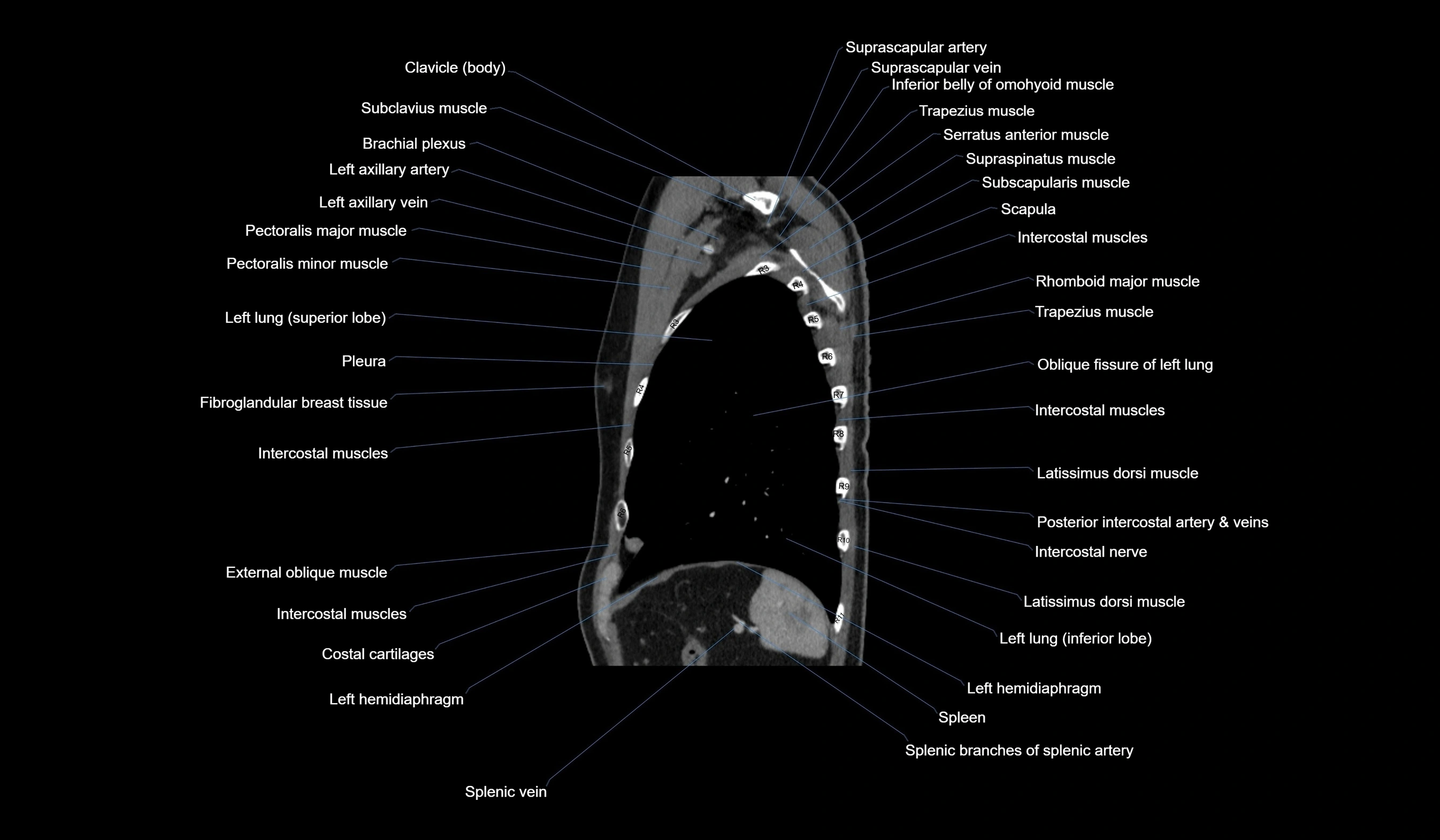CT chest (thorax) soft tissue window labelled sagittal cross sectional anatomy radiology image-00115.webp